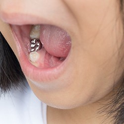 A child with a stainless-steel crown