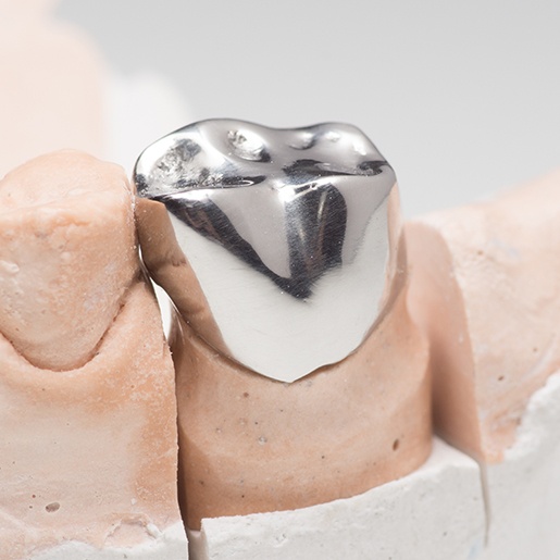 Metal dental crown on smile model