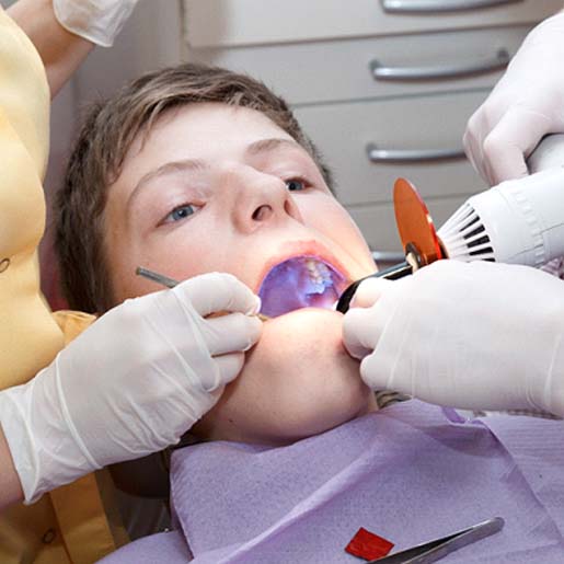 Dentist applying dental sealants in Willow Park 