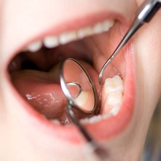 Dentist checking dental sealants in Willow Park 