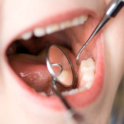 Dentist checking dental sealants in Willow Park 