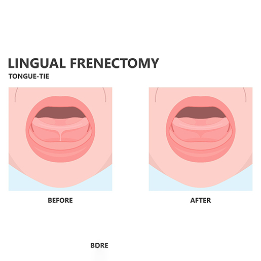 Before and after of a lingual frenectomy